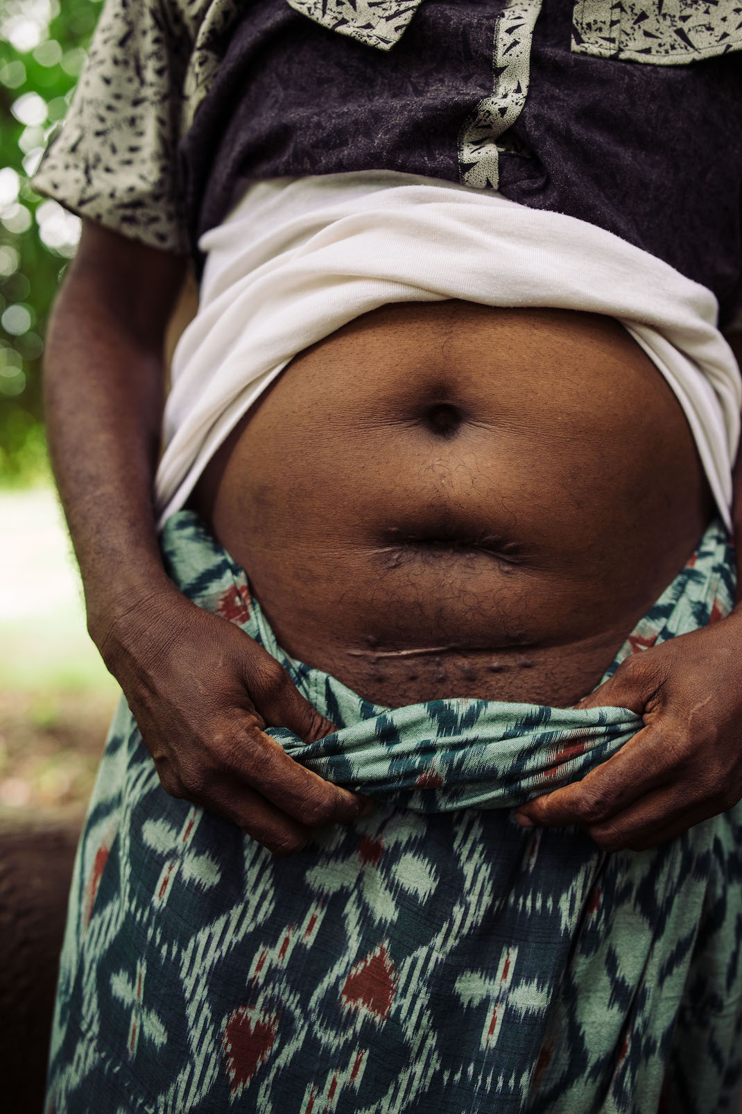 a man shows his stomach which has horizontal healed scars