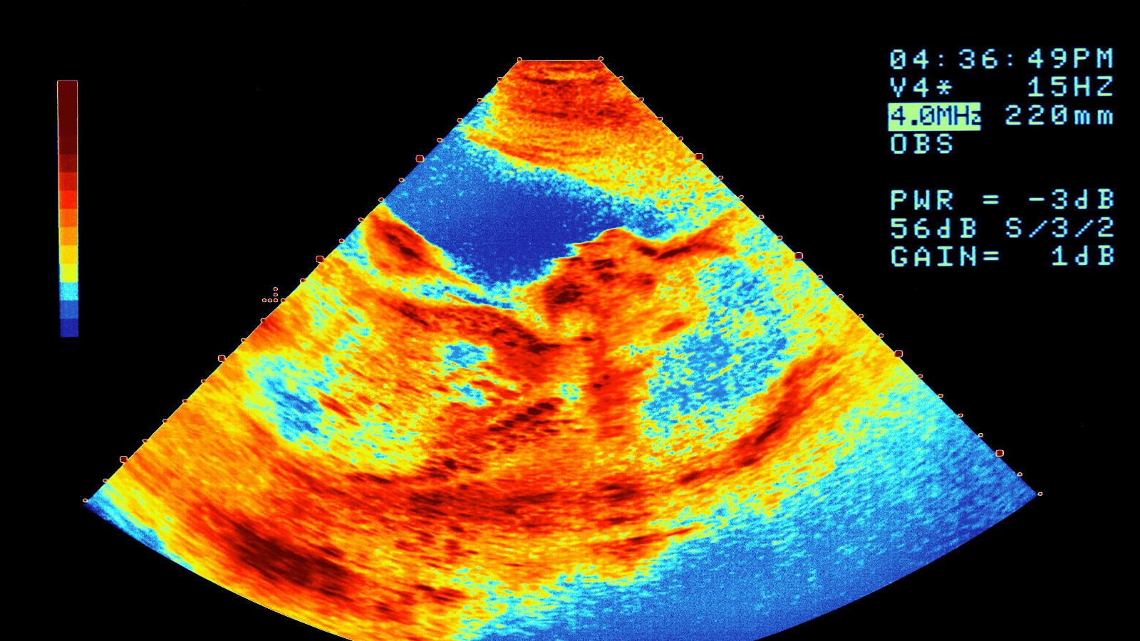 An image of an ultrasound showing heat levels