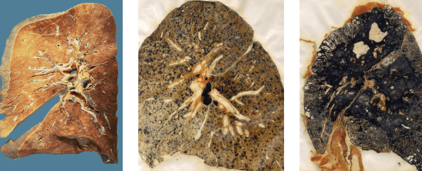 Three upsetting images of lungs damaged by black lung disease